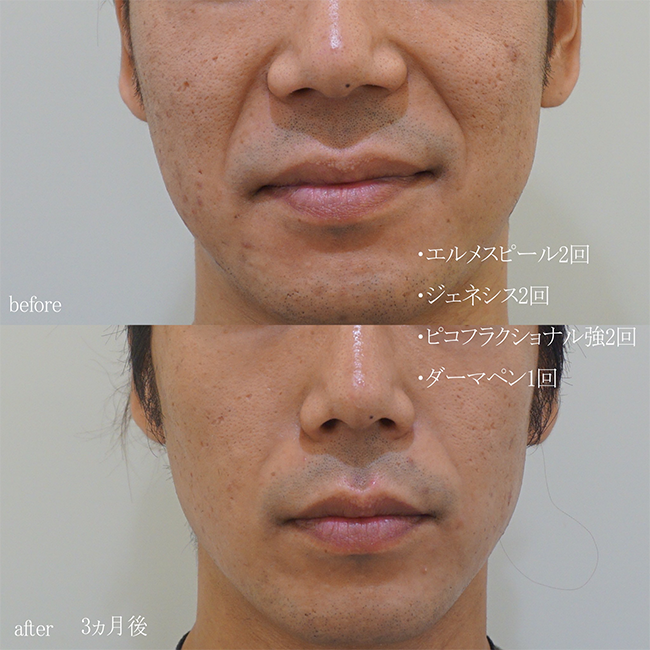 画像:実際に当院で毛穴治療を受けた患者様の症例画像