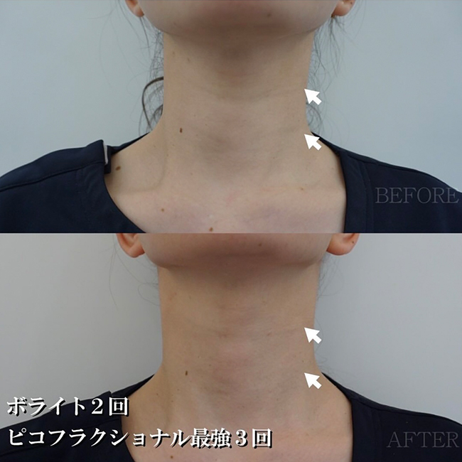 画像:実際に当院で毛穴治療を受けた患者様の症例画像