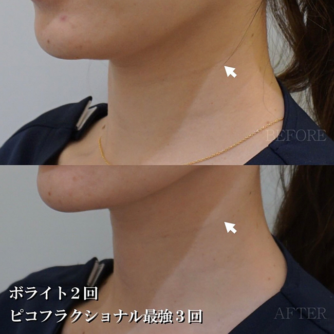 画像:実際に当院で毛穴治療を受けた患者様の症例画像
