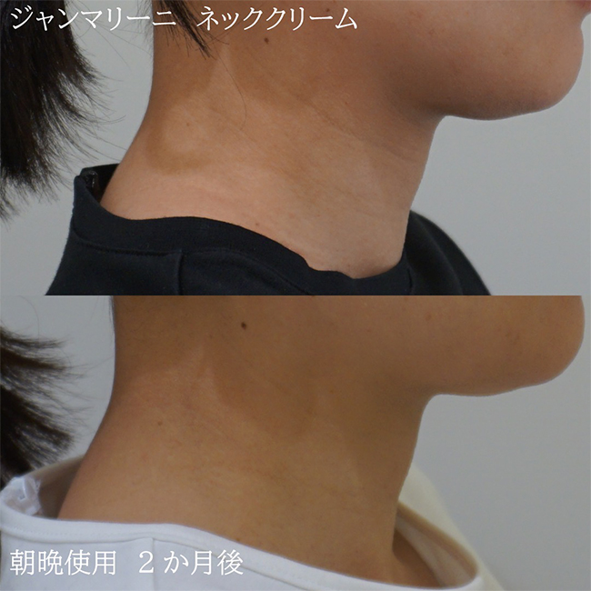 画像:実際に当院で毛穴治療を受けた患者様の症例画像